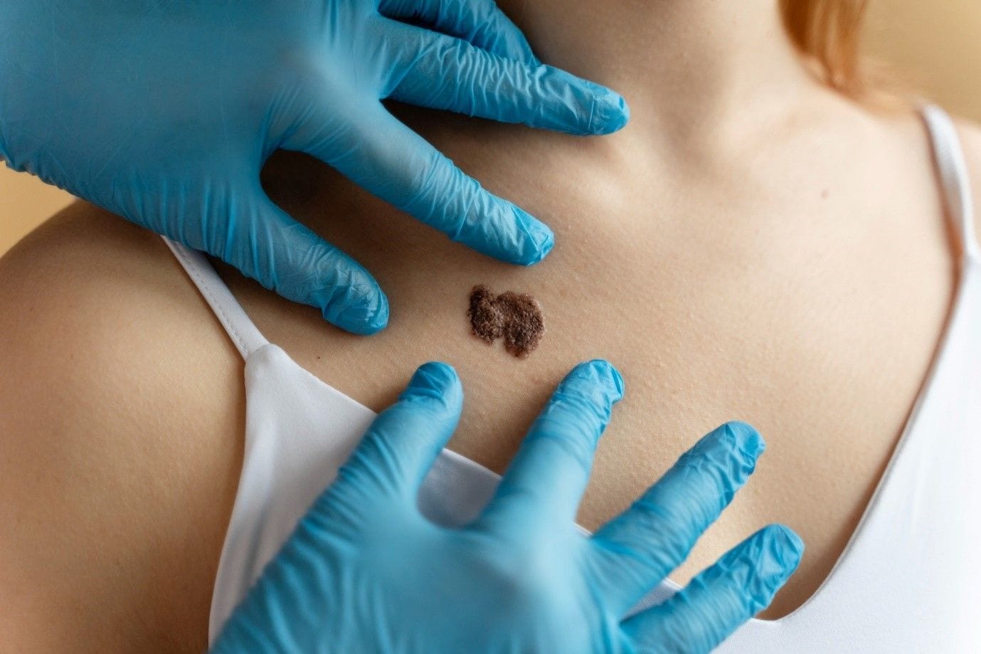 Skin Tags vs. Moles Decoding the Difference