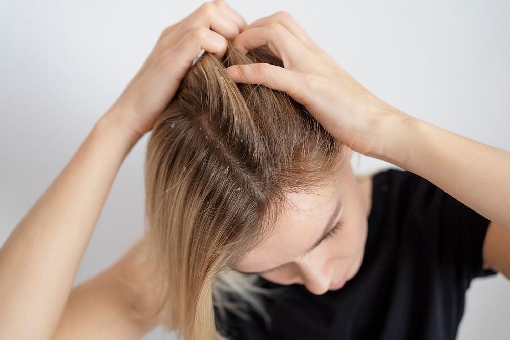 How to prevent scalp acne (Image via Freepik)