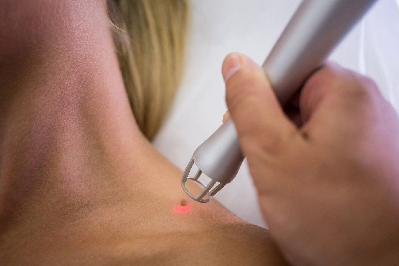 People usually get Skin Tags and Moles removed due to cosmetic reasons (Image by Wavebreakmedia_micro on Freepik)