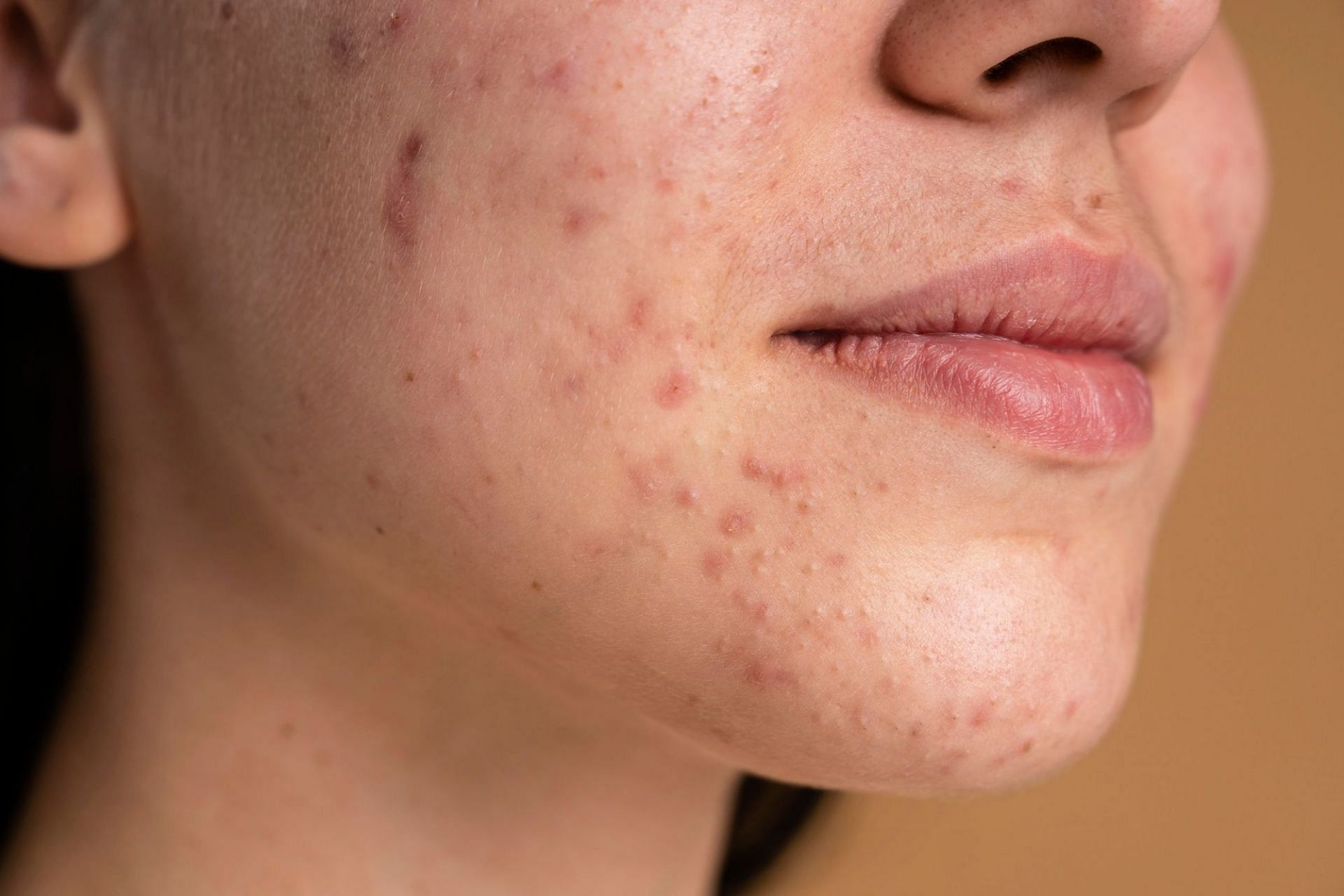 Vitamin B3 reduces acne. (Photo via Freepik)
