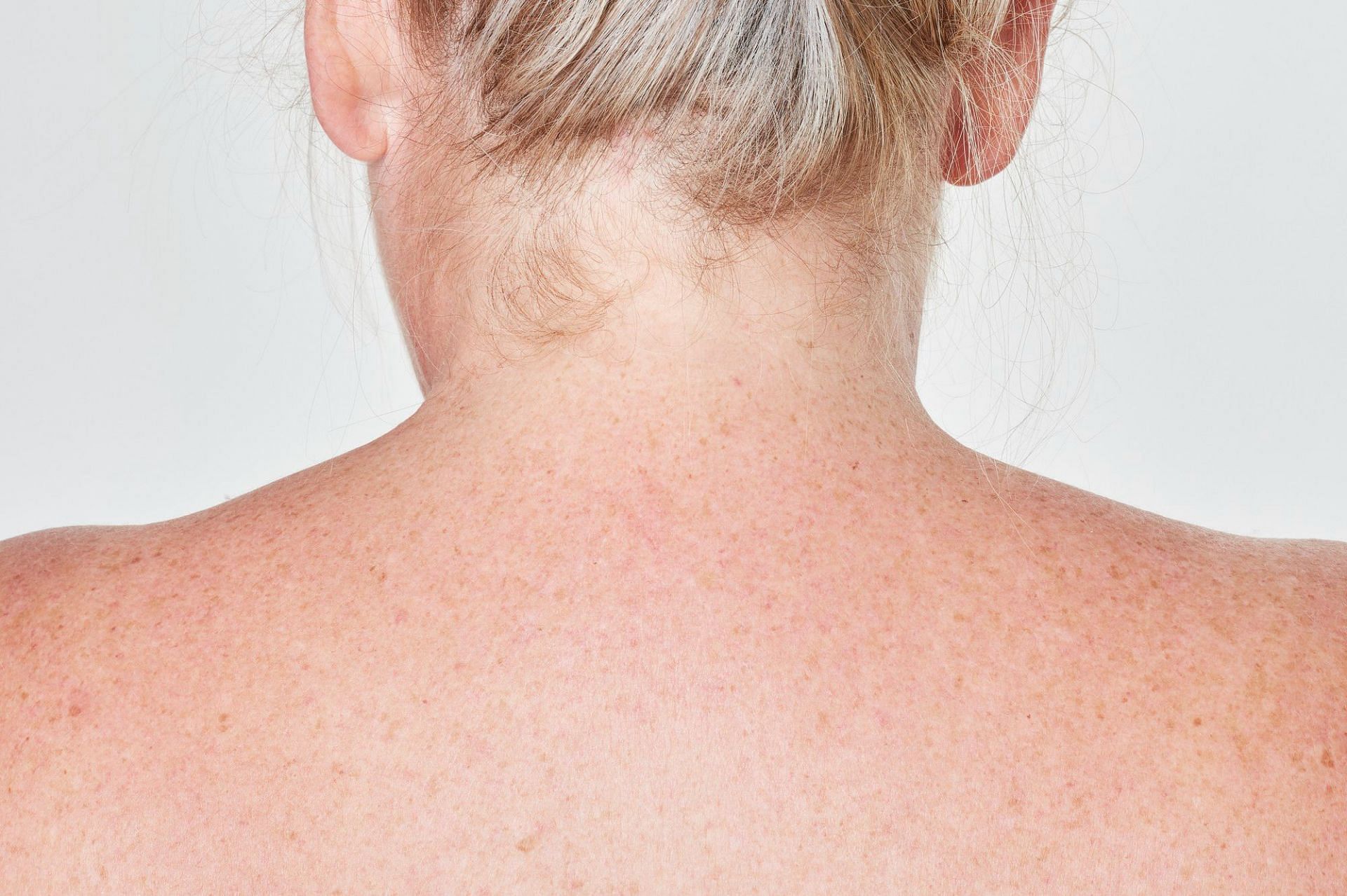 Hyperpigmentation on neck can happen due to several reasons. (Photo via Freepik/rawpixel.com)