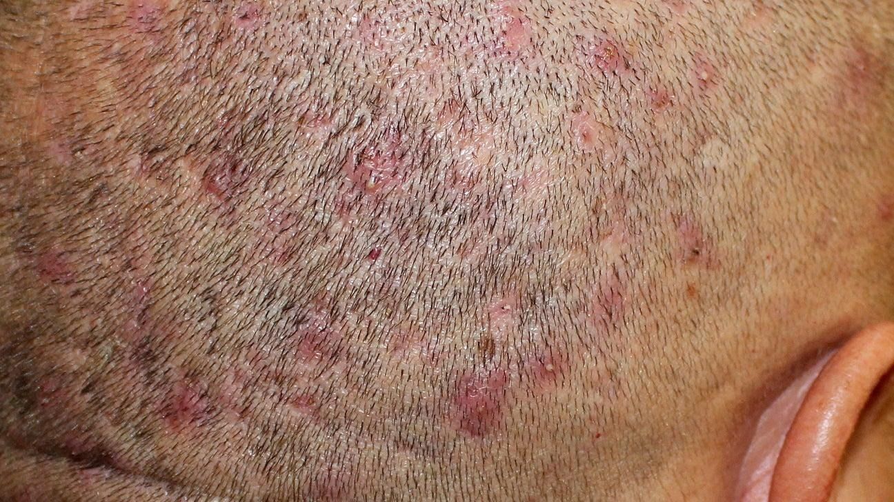Scalp scabs (Image via Getty Images)