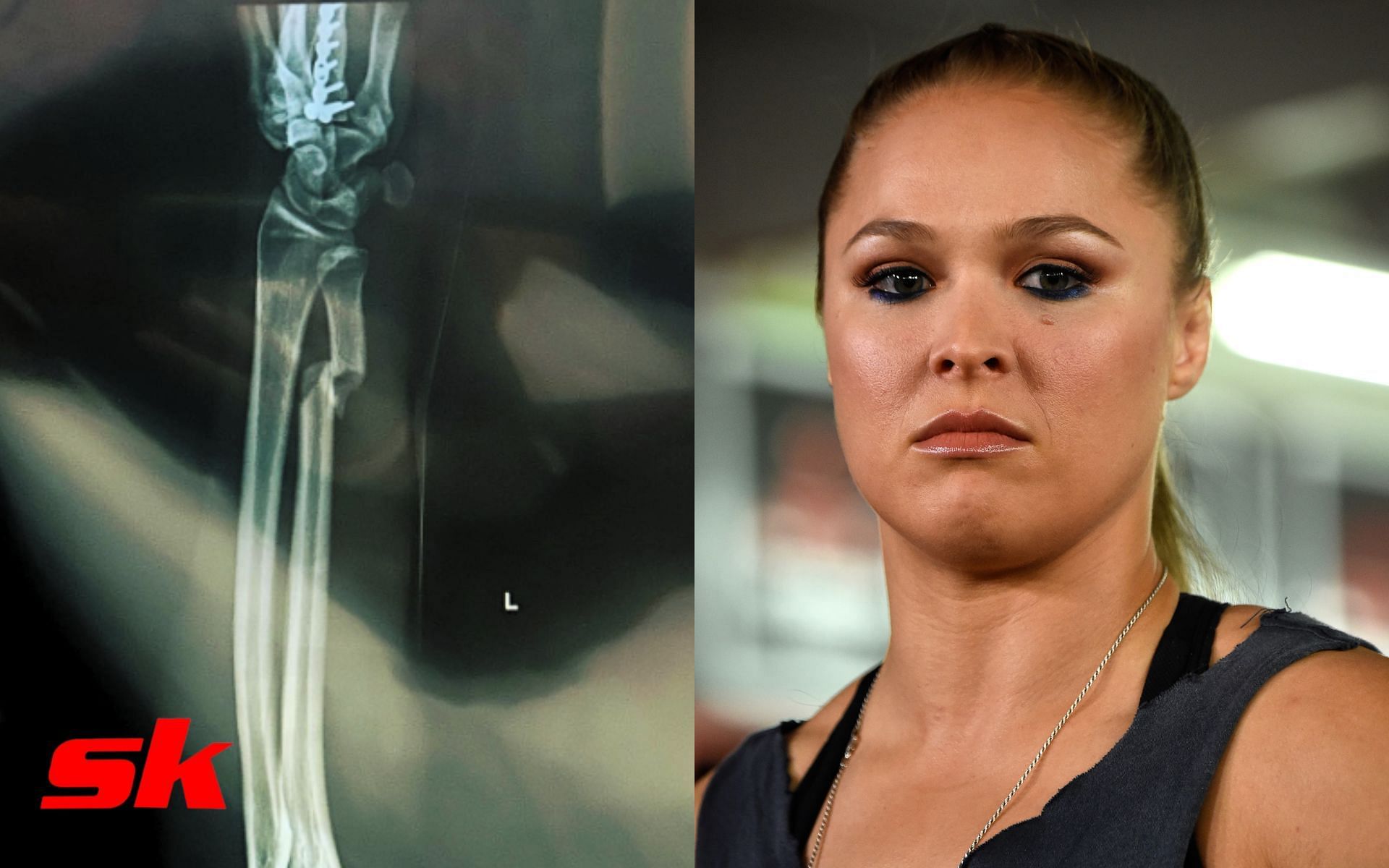 X-ray of broken bone (left - via Alex Caceres