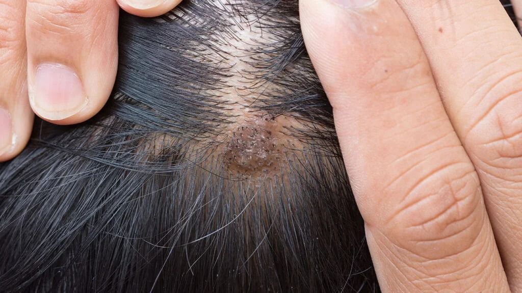 Scalp scab The ideal way to deal with it