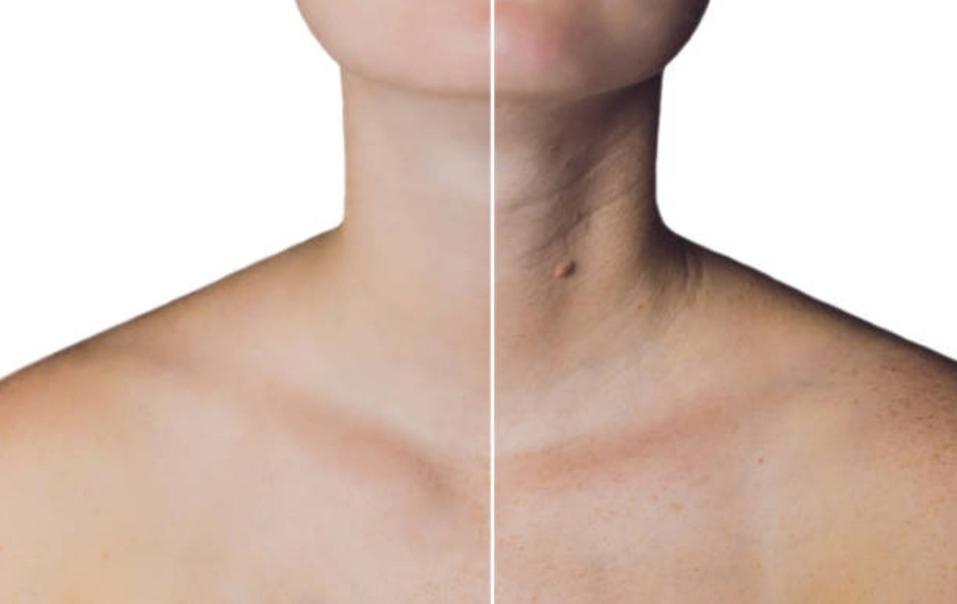 The Barbie Botox treatment targets the trapezius muscles in the shoulders and upper back (image via iStock)