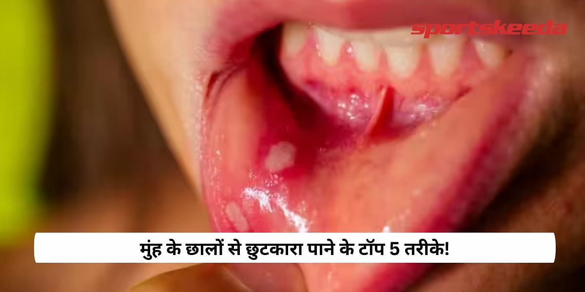 top 5 ways to get rid of mouth ulcers!