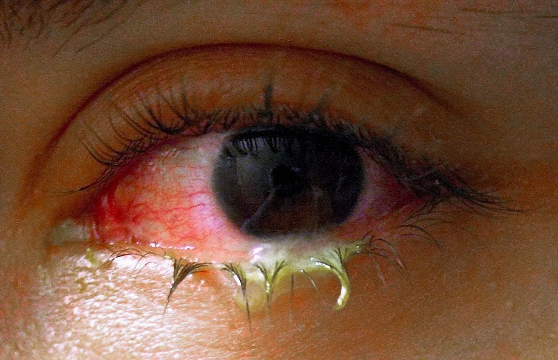 In the midst of rising cases, there are some ways in which you can tackle conjunctivitis (Image via myeyespecialist)