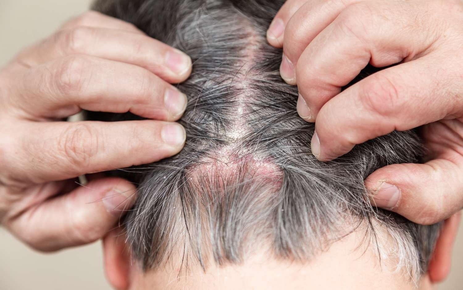 Scalp scabs (Image via Getty Images)