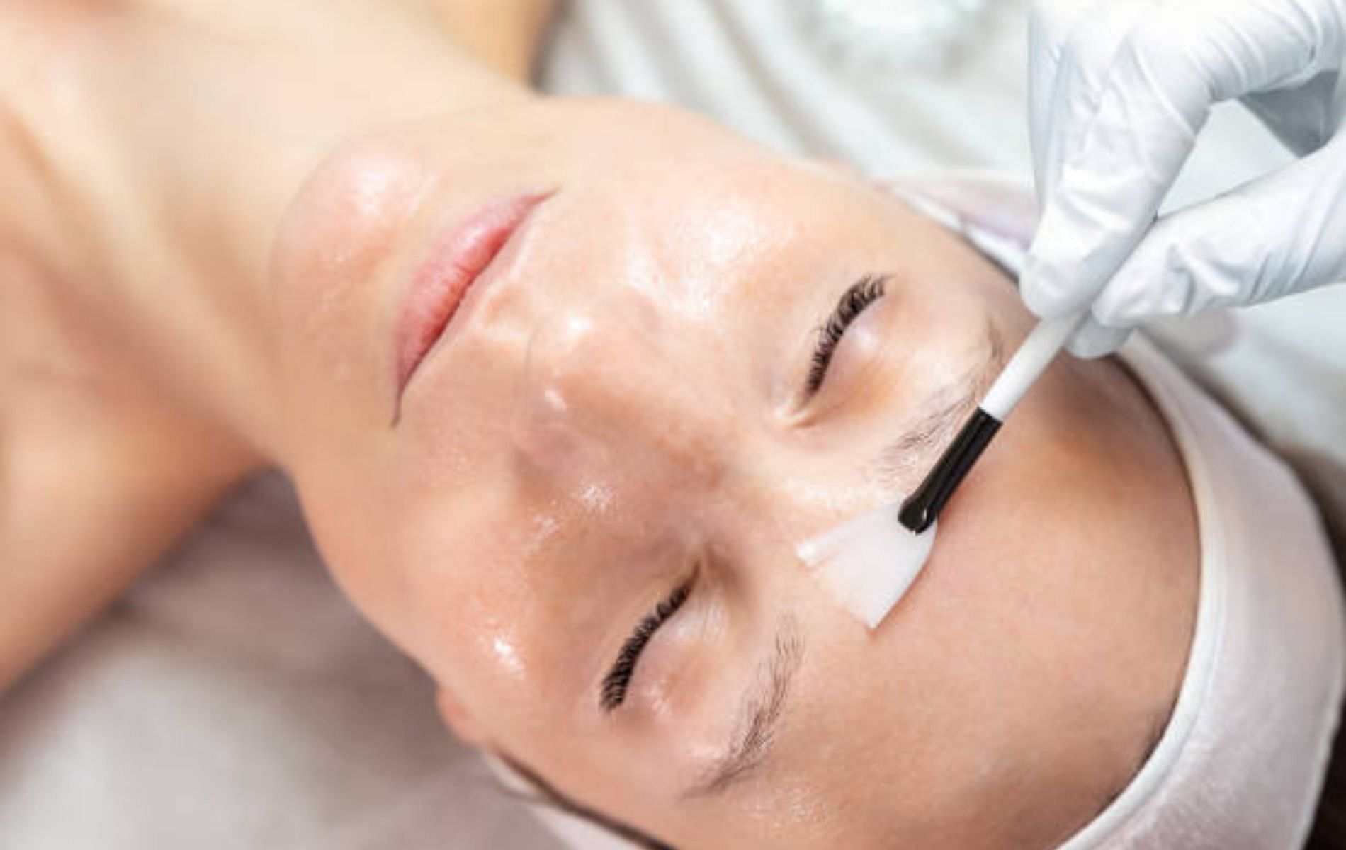 Chemical peel for skin pigmentation (Image by iStockphoto via Pexels)