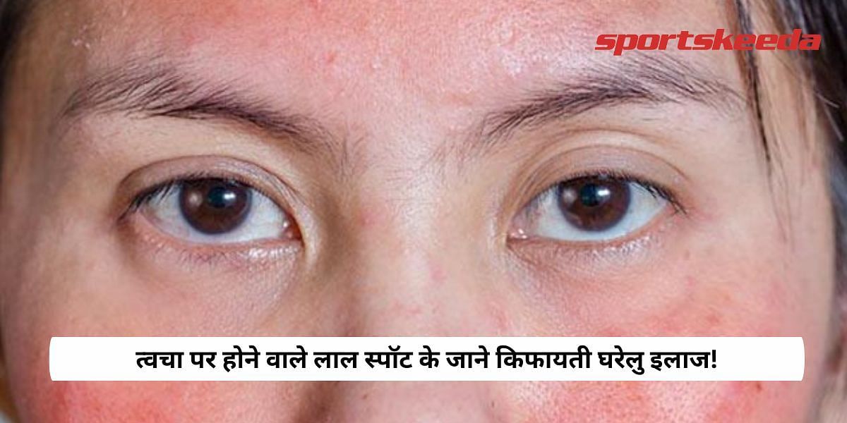 Know the affordable home remedies for red spots on the skin!
