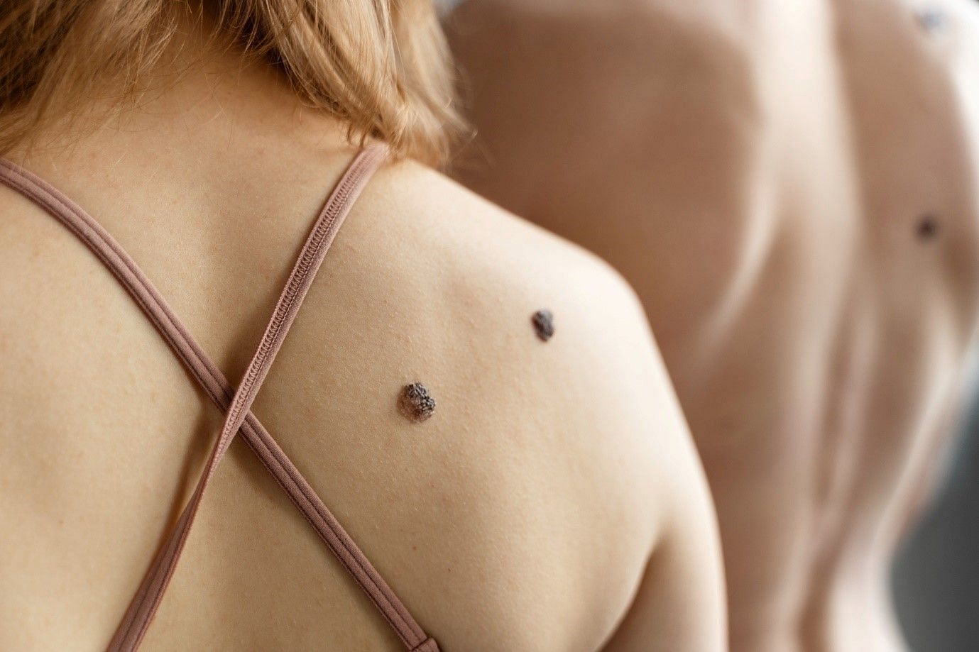 Skin Tags and Moles are the most common skin issues (Image by Freepik on Freepik)