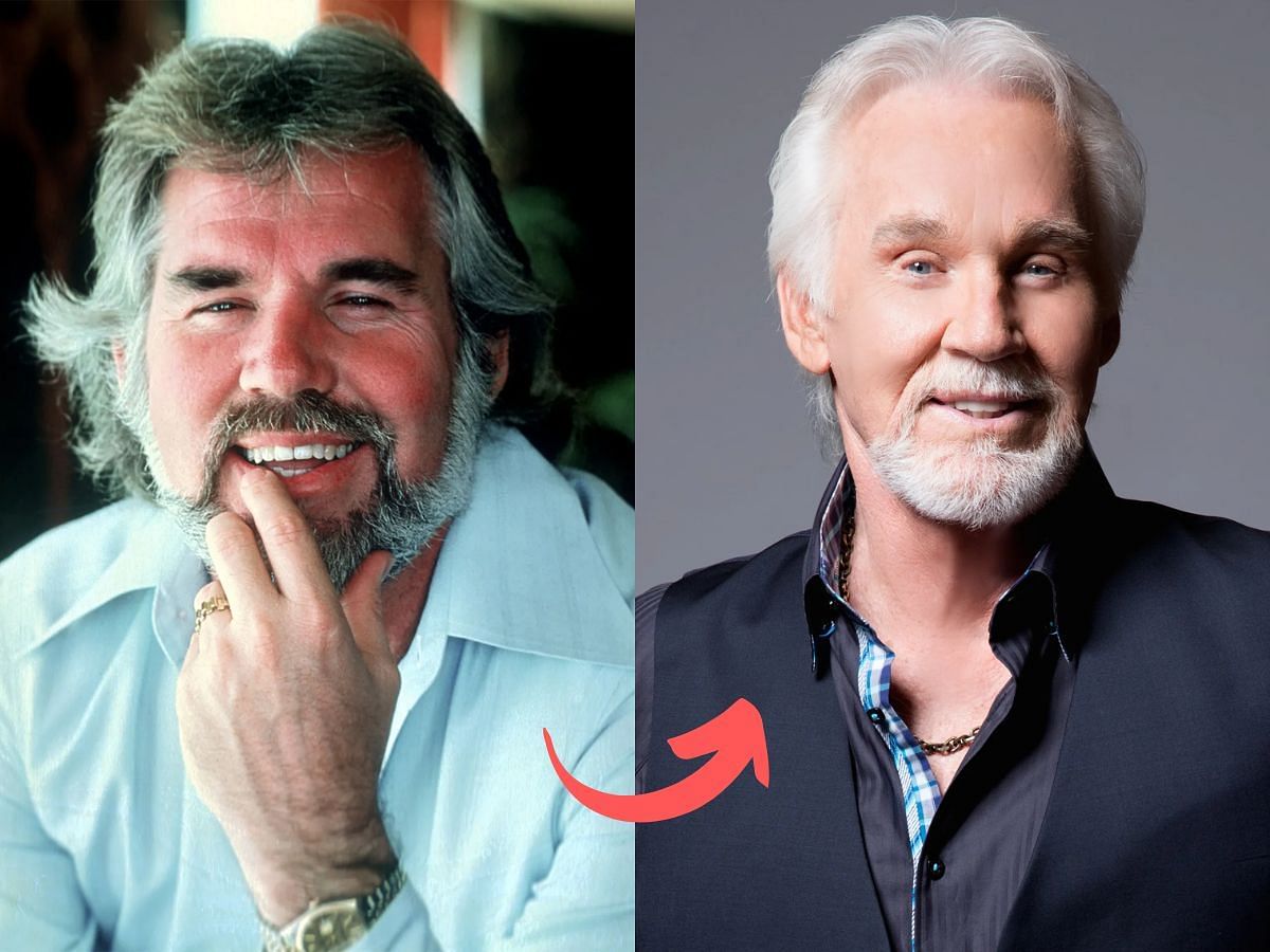 Kenny Rogers before (left) and after (right) surgery (Images via Getty)