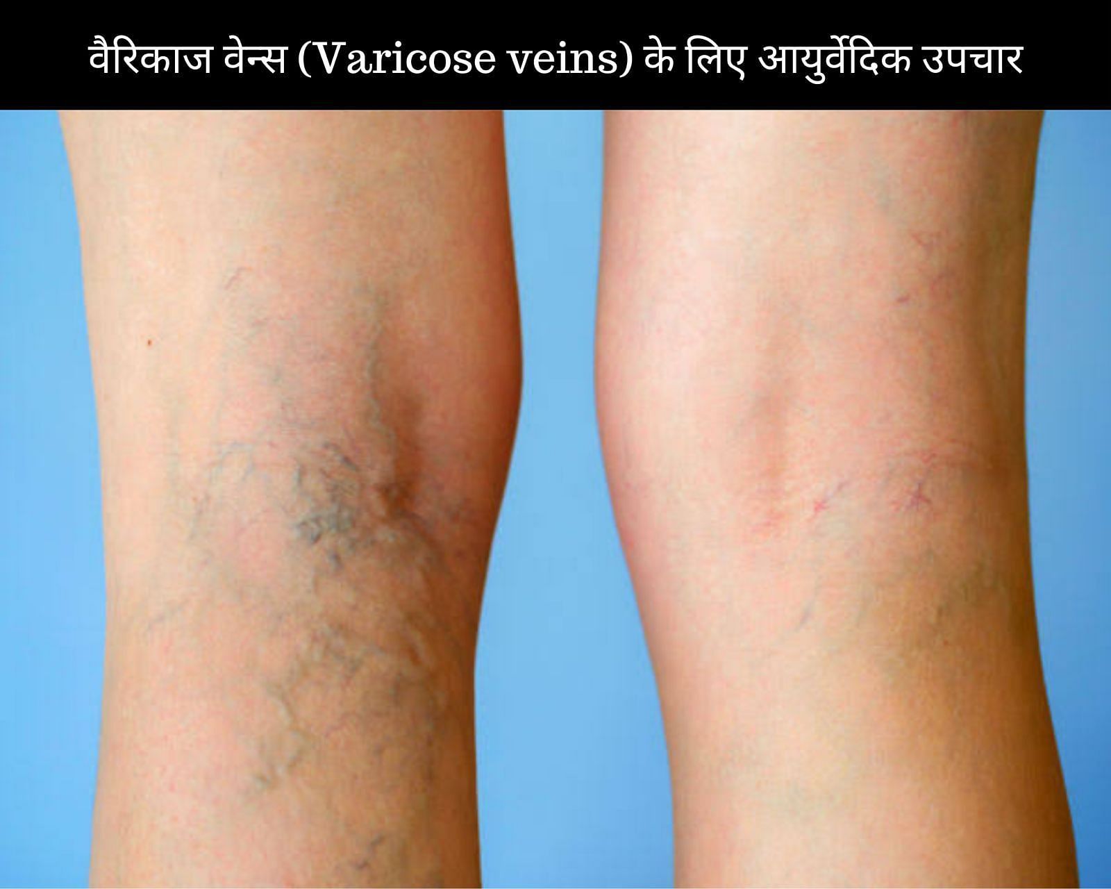 वैरिकाज वेन्स (Varicose veins) के लिए 10 आयुर्वेदिक उपचार (फोटो - sportskeedaहिन्दी)