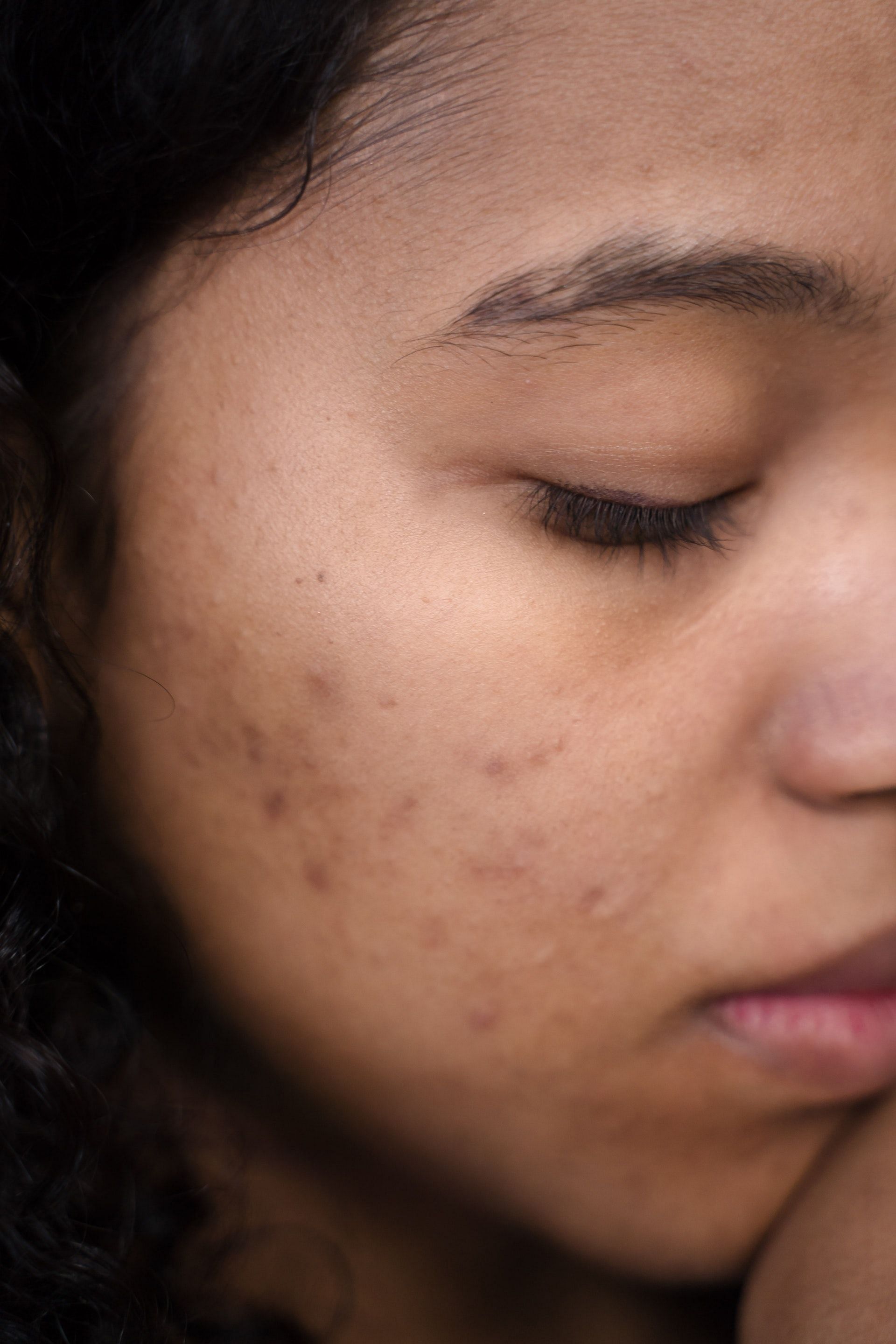 Scrubbing helps in removal of Body acne (Image by Ron Lach/Pexels)