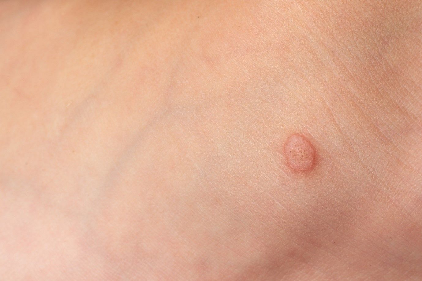 Dangling Skin Tags are expected to go away more easily. (Image by Dali_photo on Vecteezy)