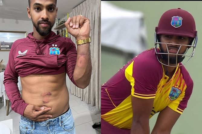 Nicholas Pooran shows bruises sustained after blows by Brandon King and Arshdeep Singh in the 5th T20I