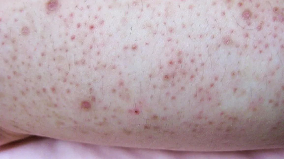 Keratosis pilaris (Image via Getty Images)