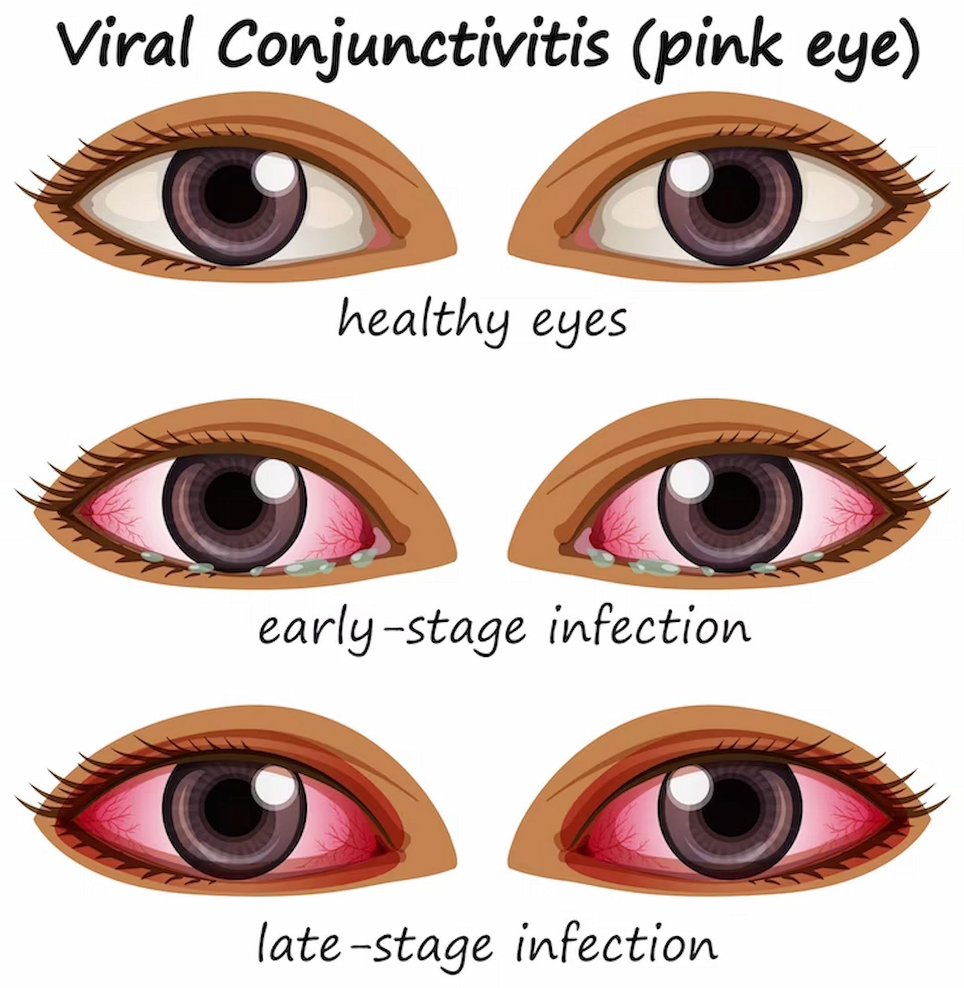 There are some stark differences between viral and bacterial pink eye which sets them apart (Image via freepik/brgfx)