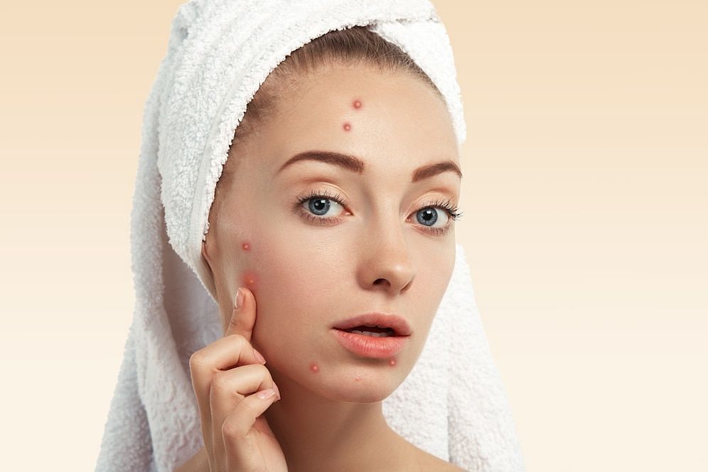 Tiktok skincare says cyanide can reduce acne (Image via freepik./wayhomestudio)