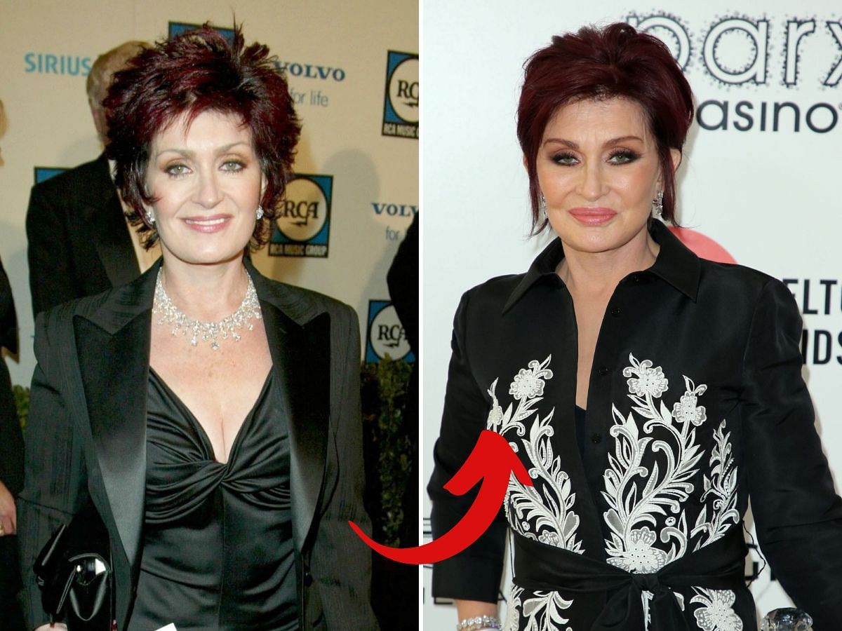 Sharon Osbourne before (left) and after (right) surgery (Images via Getty)