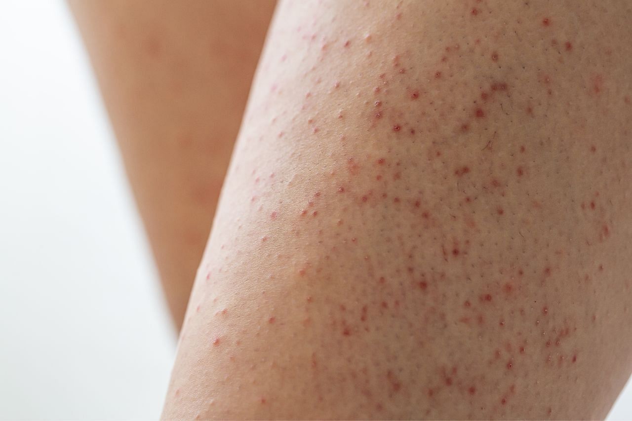 Keratosis pilaris (Image via Getty Images)