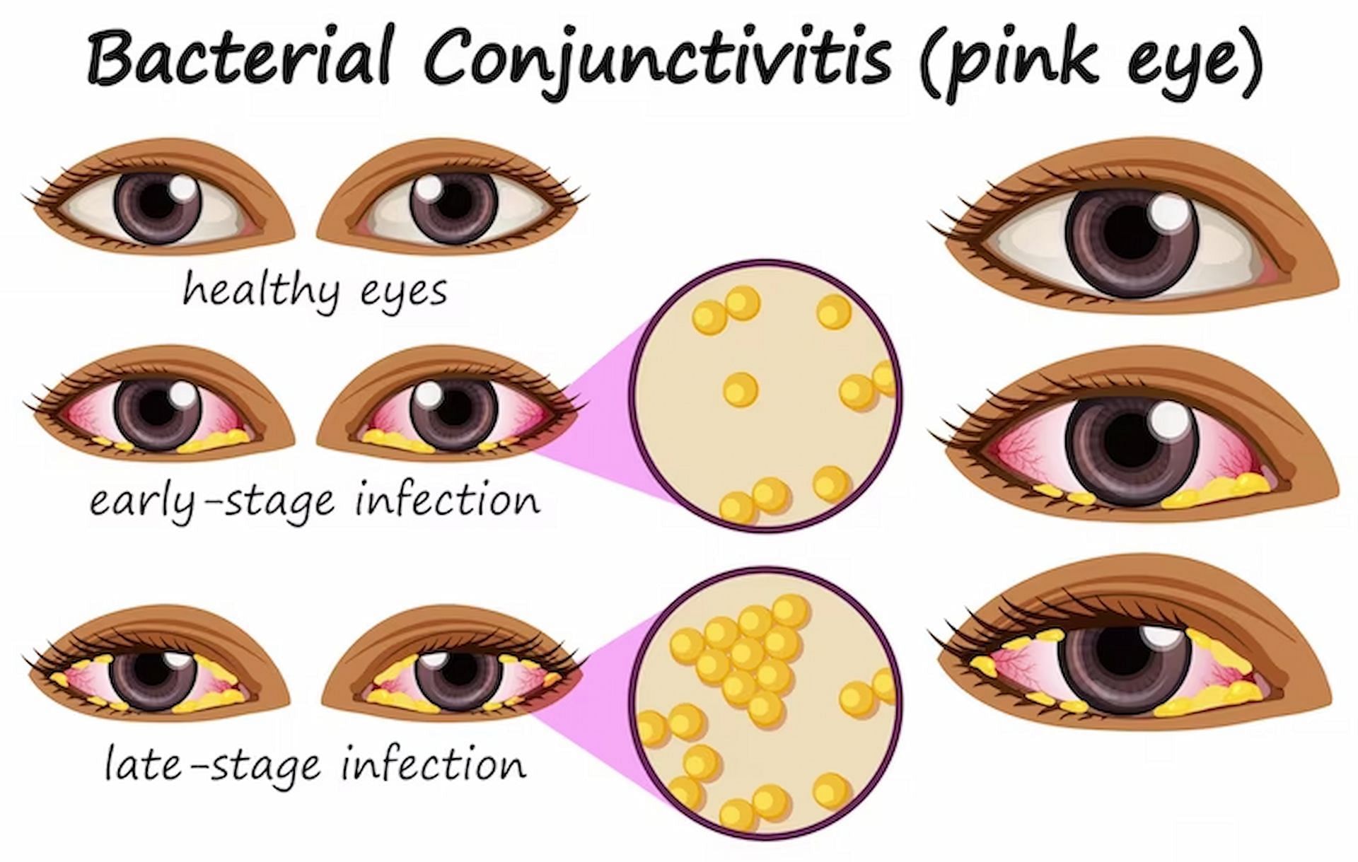 In terms of intensity, bacterial pink eye is far worse than viral pink eye (Image via freepik/brgfx)