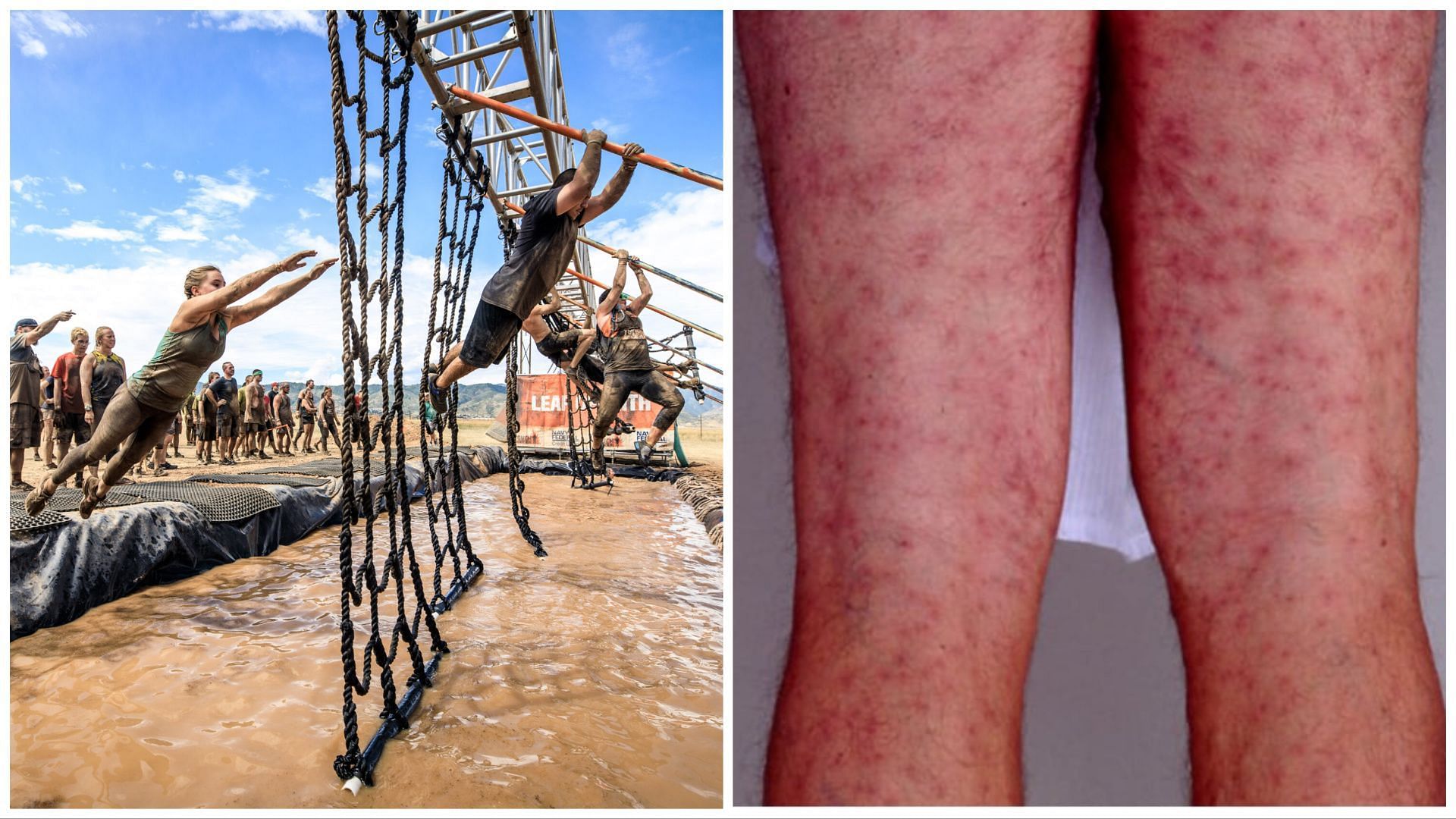 Tough Mudder athletes are now suffering from the skin problem (Image via Associated Press / Mayo Clinic)