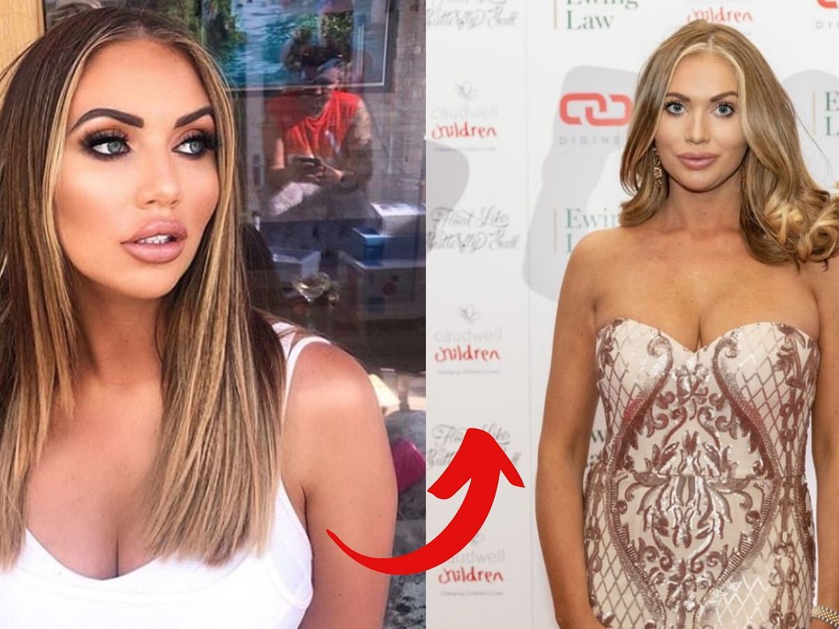 Amy Childs before (left) and after (right) surgery (Images via Getty)