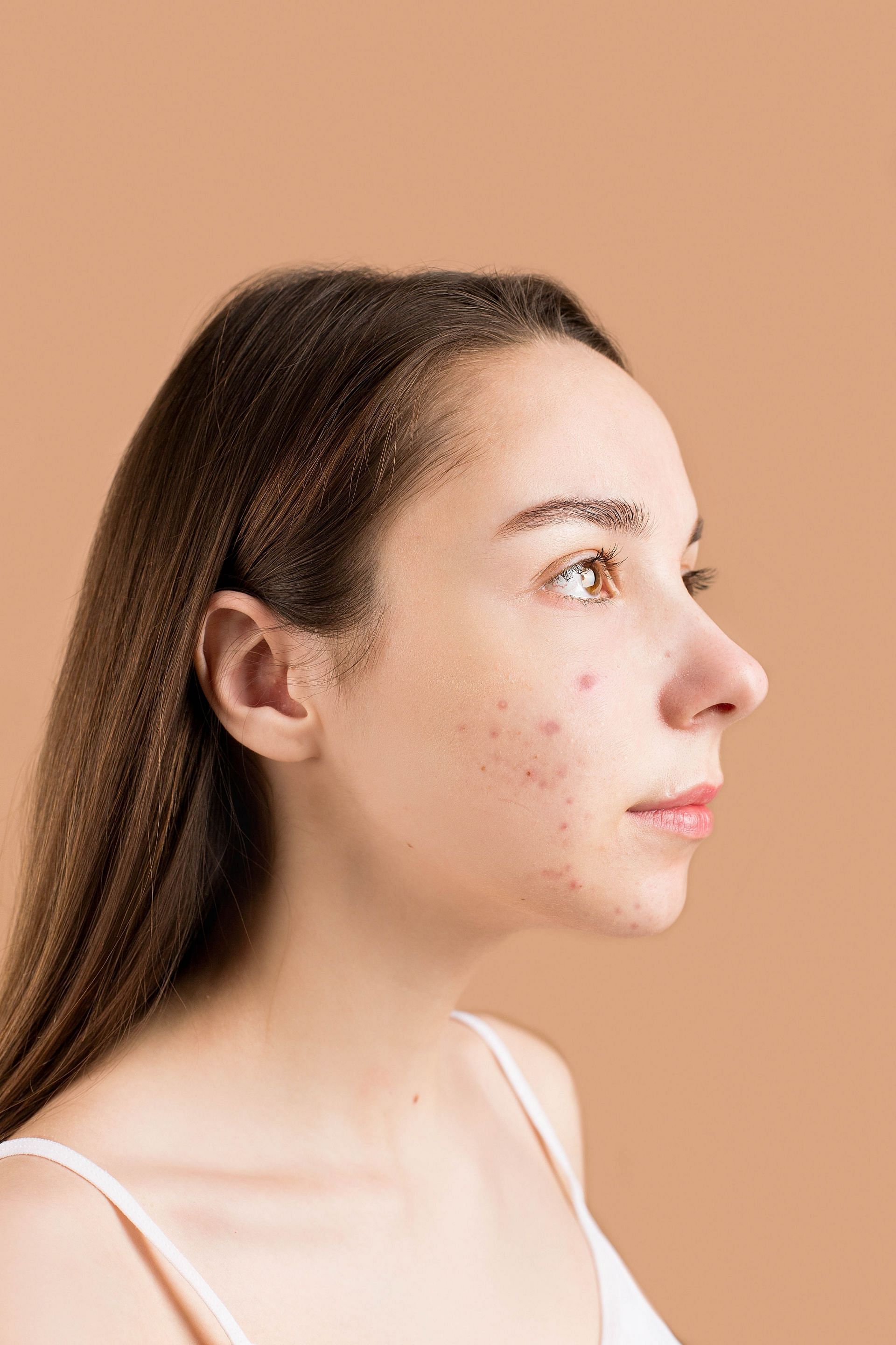 How BHA Works on Acne-Prone Skin. (Image via Pexels)