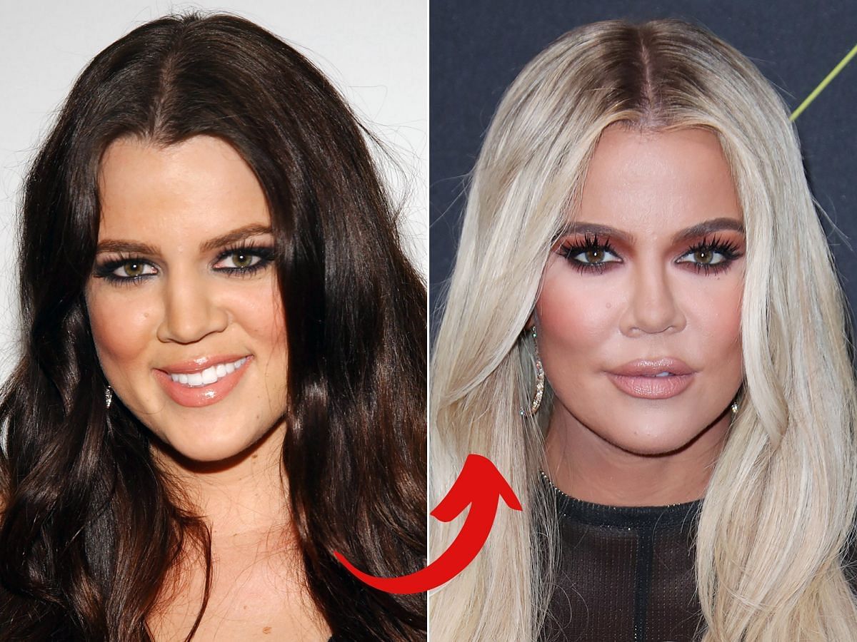 Khloe Kadarshian before (left) and after (right) surgery (Images via Getty)