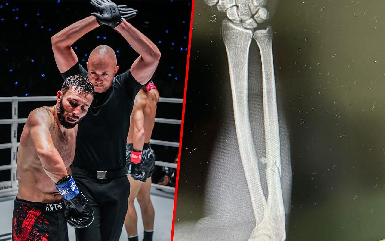 Davit Kiria shares X-ray image of his broken arm.