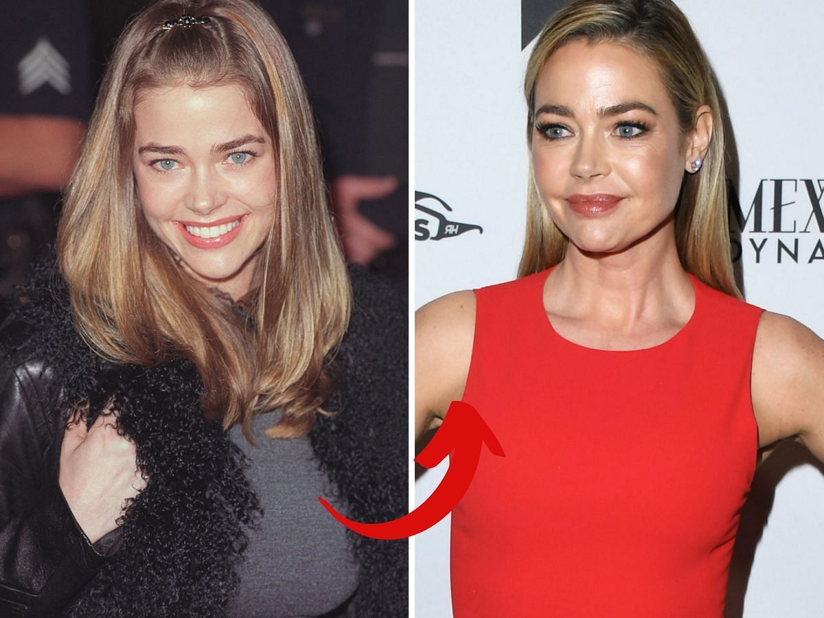 Denise Richards before (left) and after (right) surgery (Images via Getty)