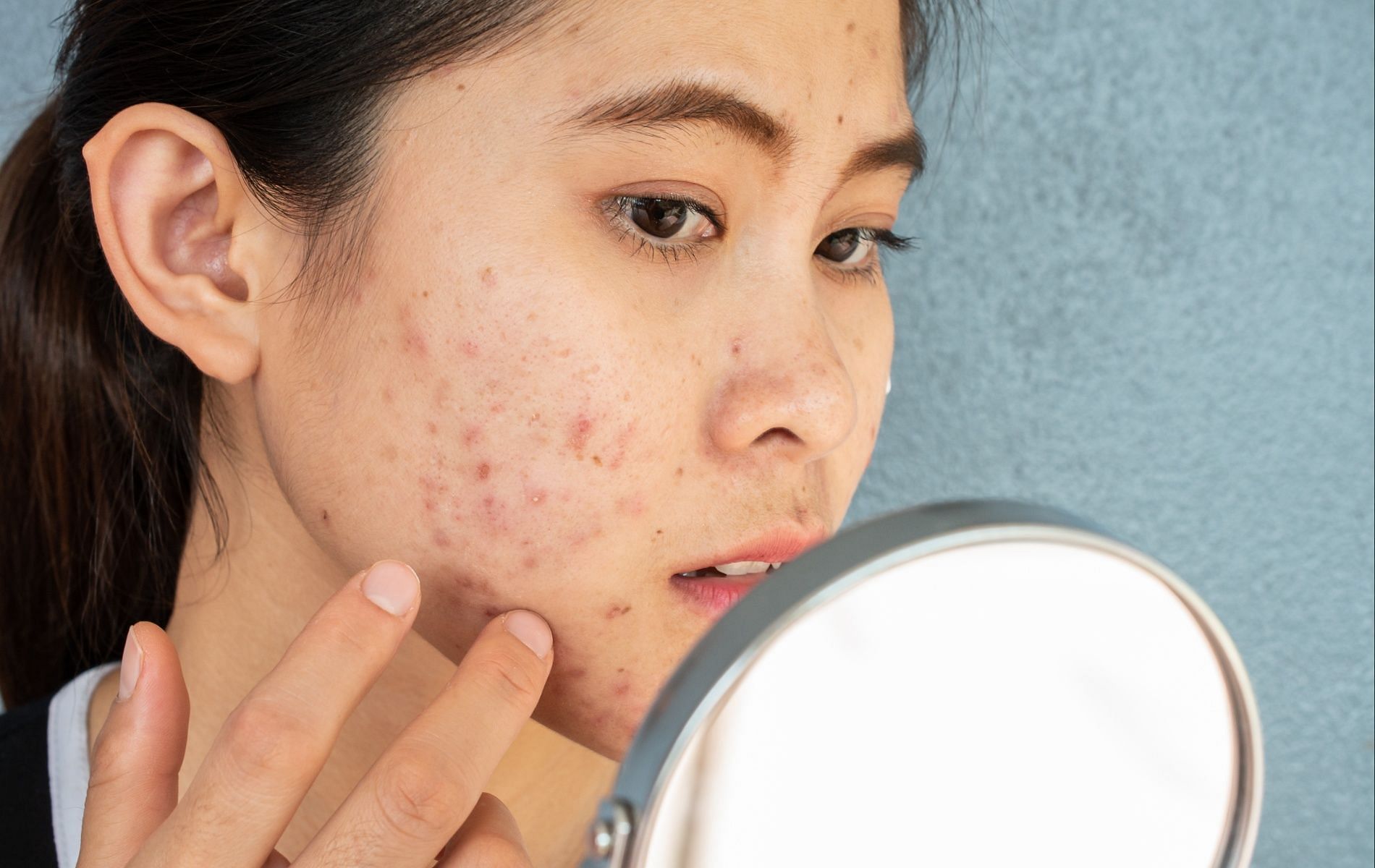 GLA in EPO might help reduce acne lesions (Image via Apotheco Pharmacy)