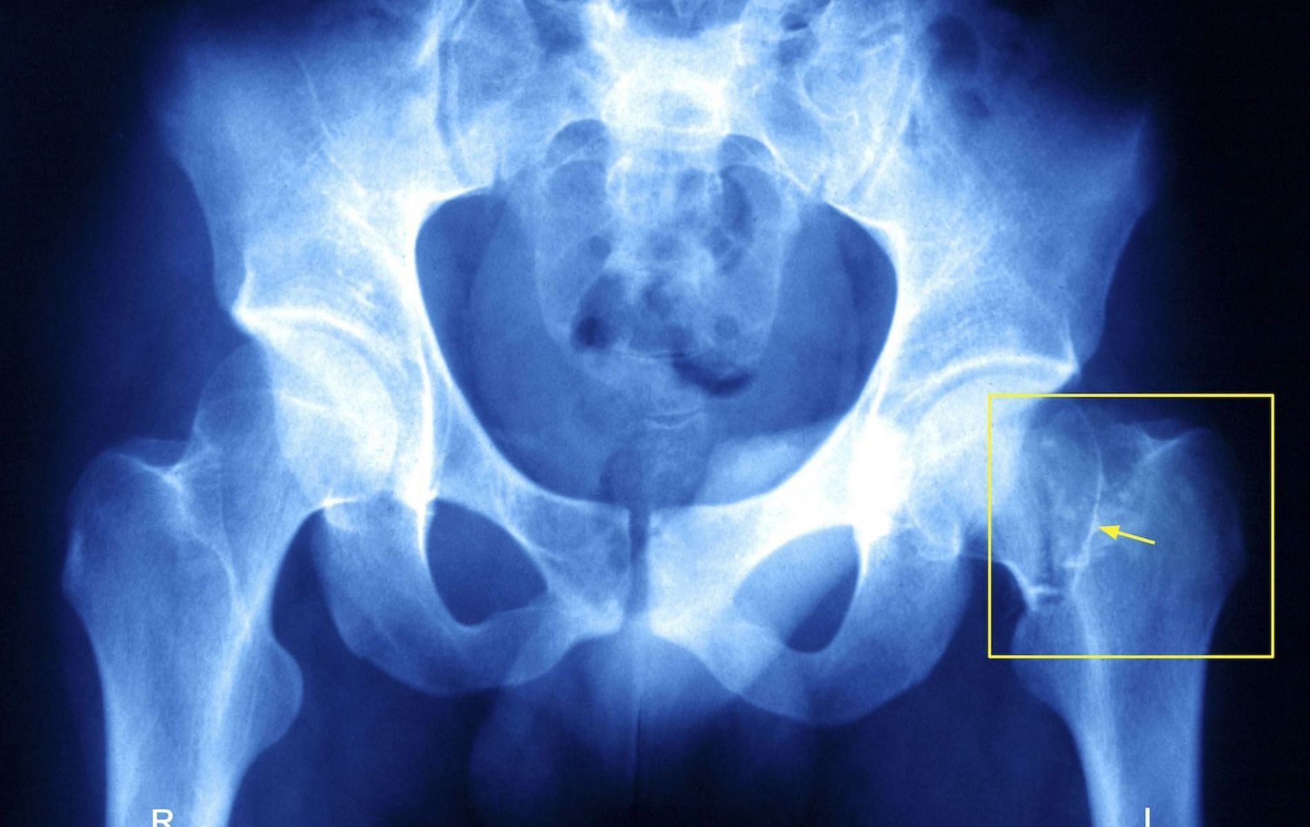 Side effects of vegetarian diet include an increased risk of hip fracture. (Image via GettyImages)