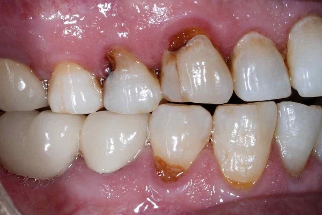 This is what you need to do if you have rotten enamel