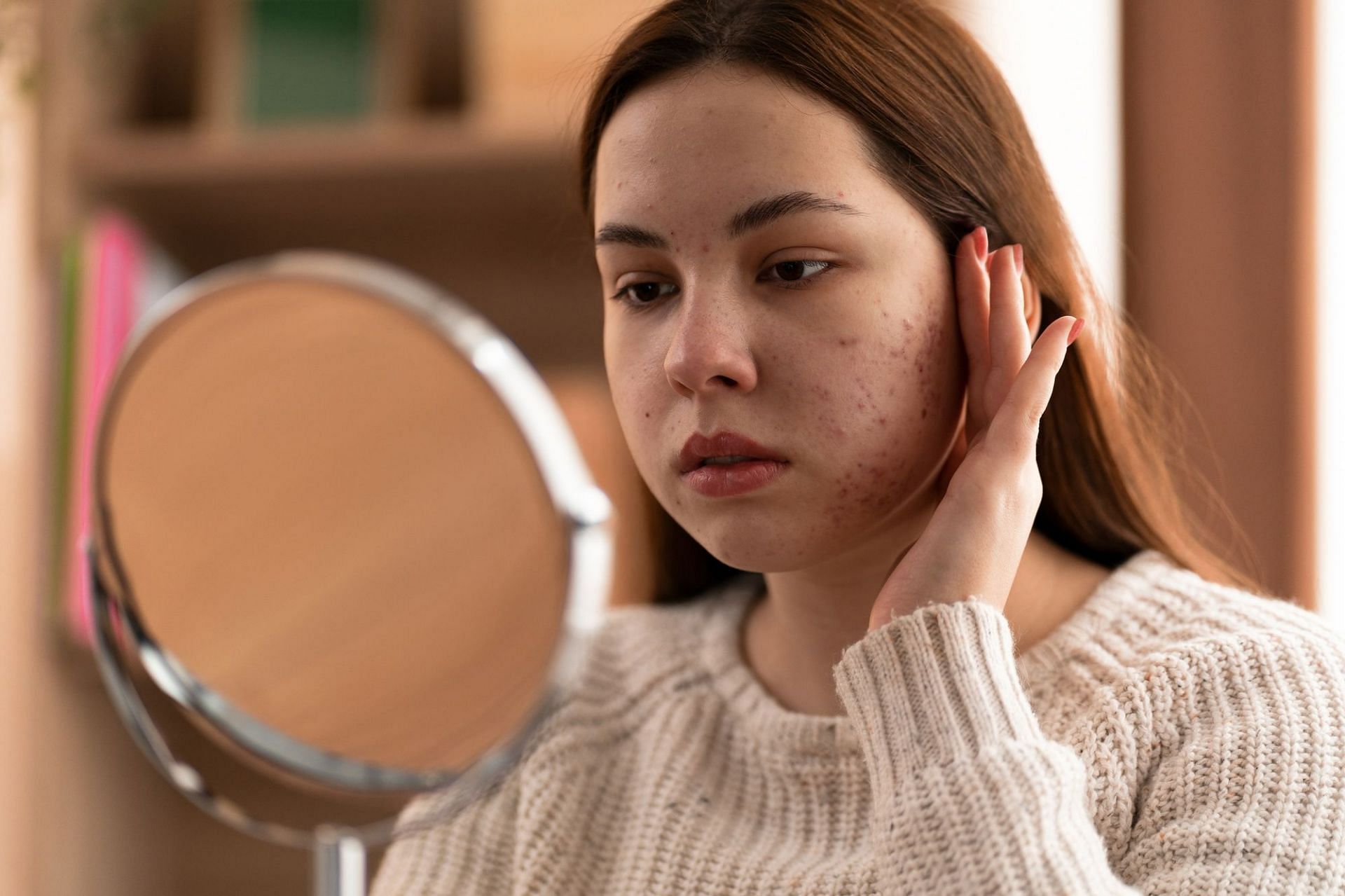 Due to stress, acne formation can either be triggered or worsen (Image by Freepik)