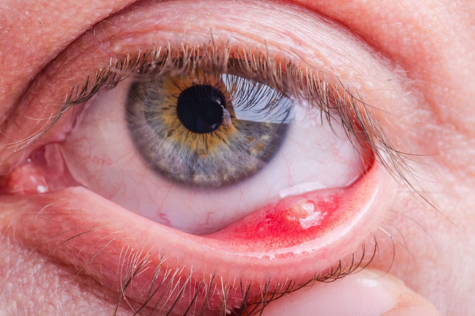 Chalazion (Image via Getty Images)