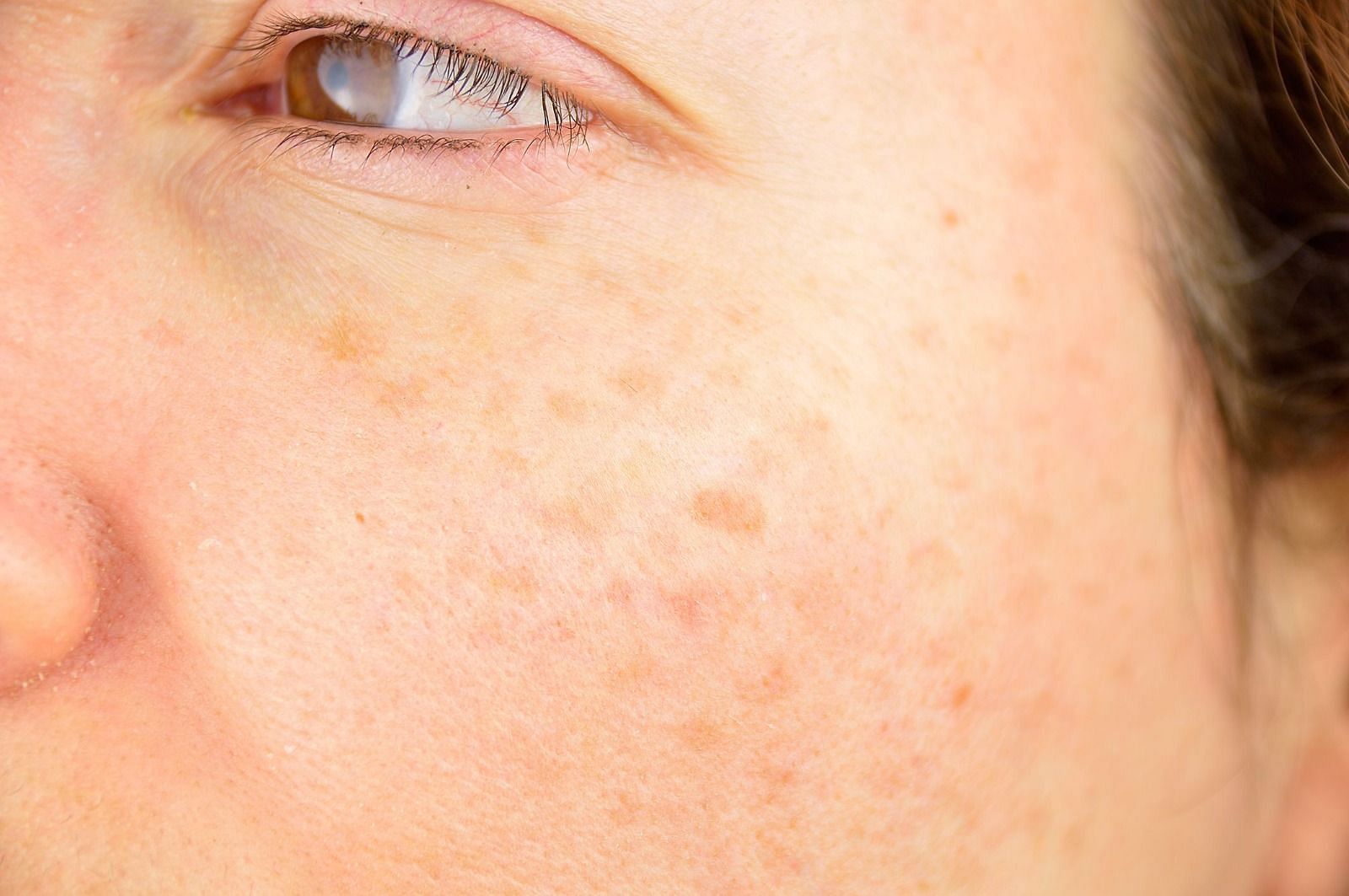 Sunspots on face (Image via Getty Images)