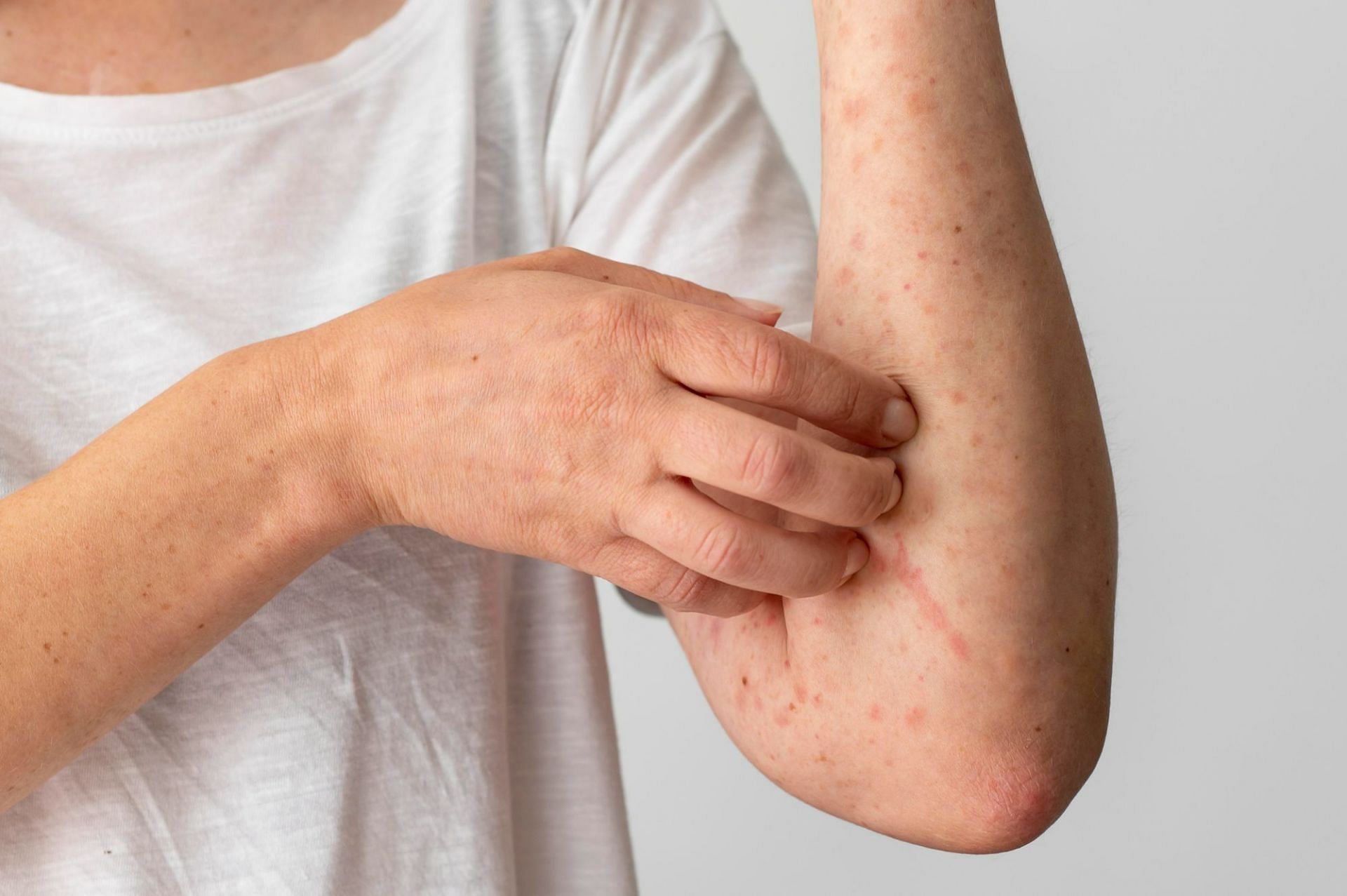 Scabies has potential to spread through skin-to-skin contact, which makes it a major threat in crowded environments (Image by Freepik on Freepik)