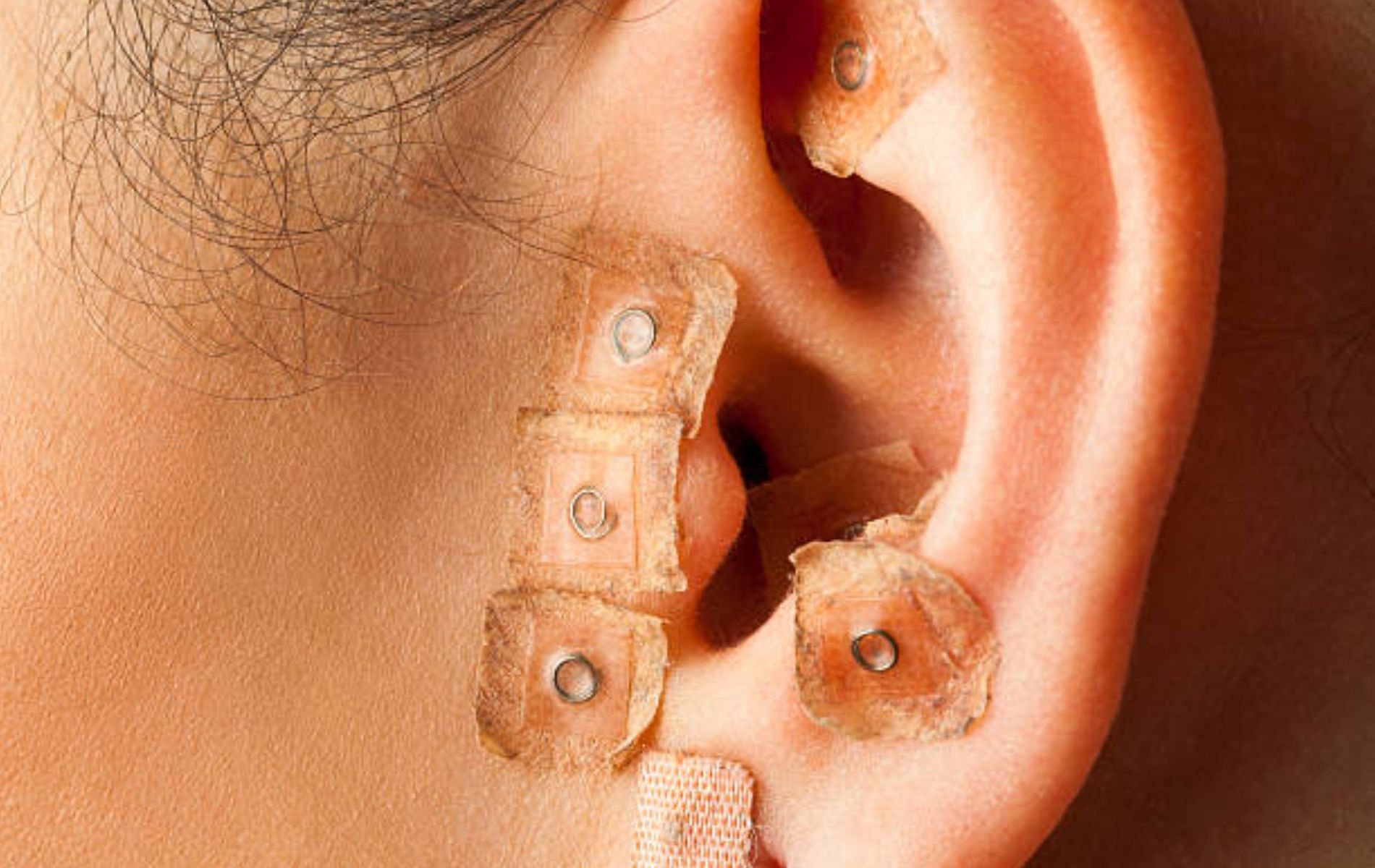 Ear seeds are used in auriculotherapy. (Image via iStockphoto) 