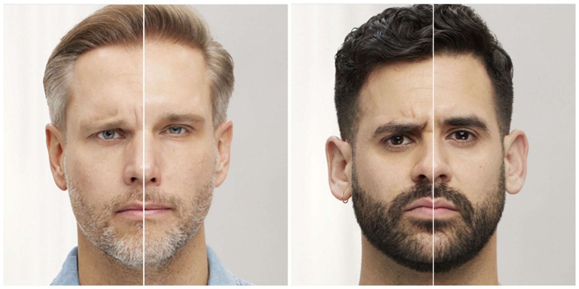 Brotox or Botox for men has been gaining popularity (Image via Botox Cosmetic)