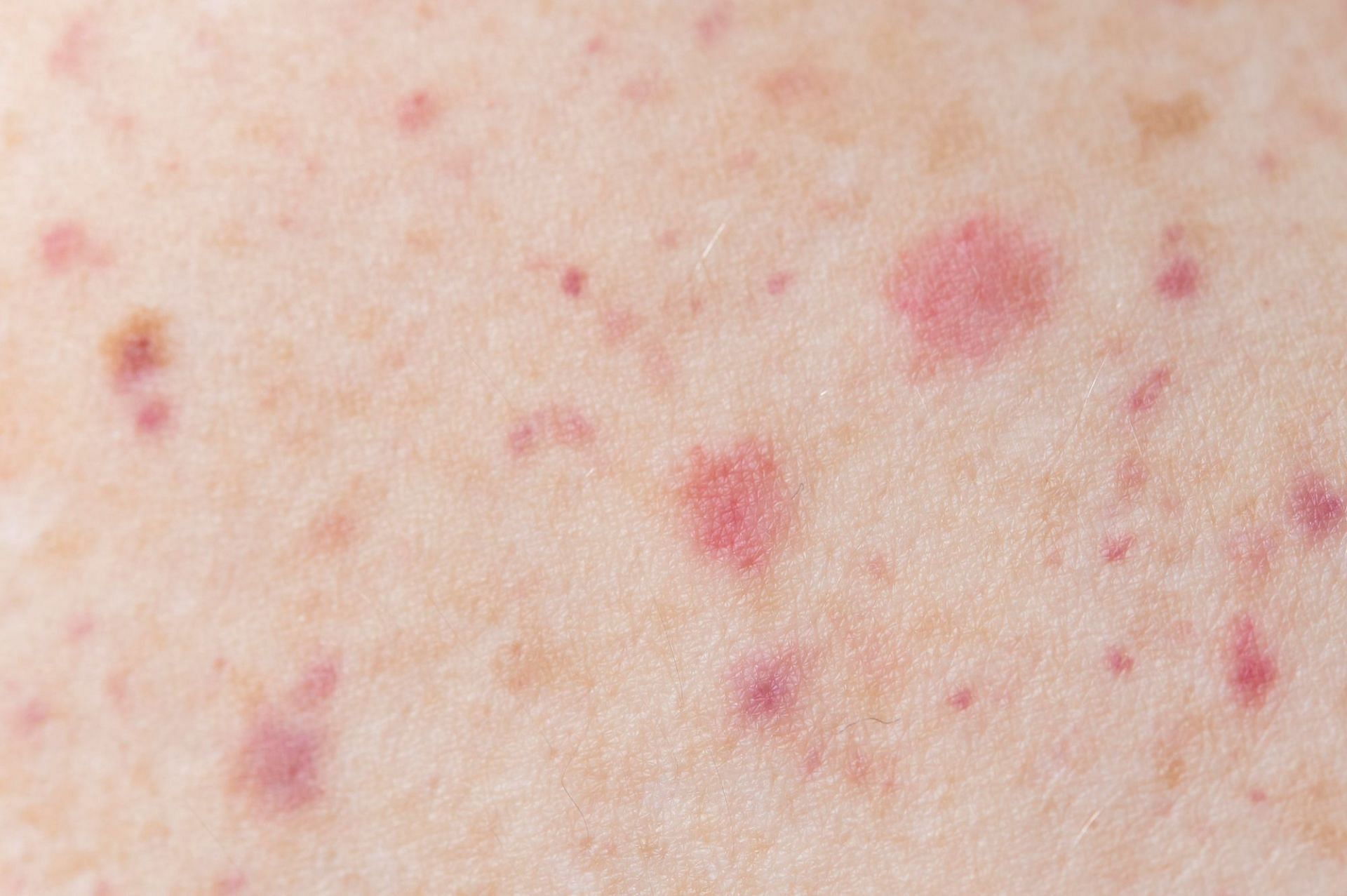 causes of rash purple