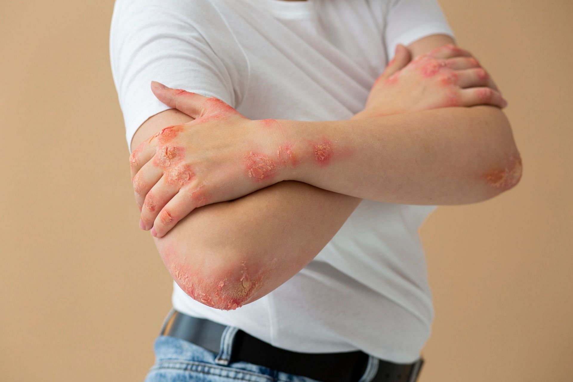 Staphylococcal scalded skin syndrome is a skin infection. (Photo via Freepik)