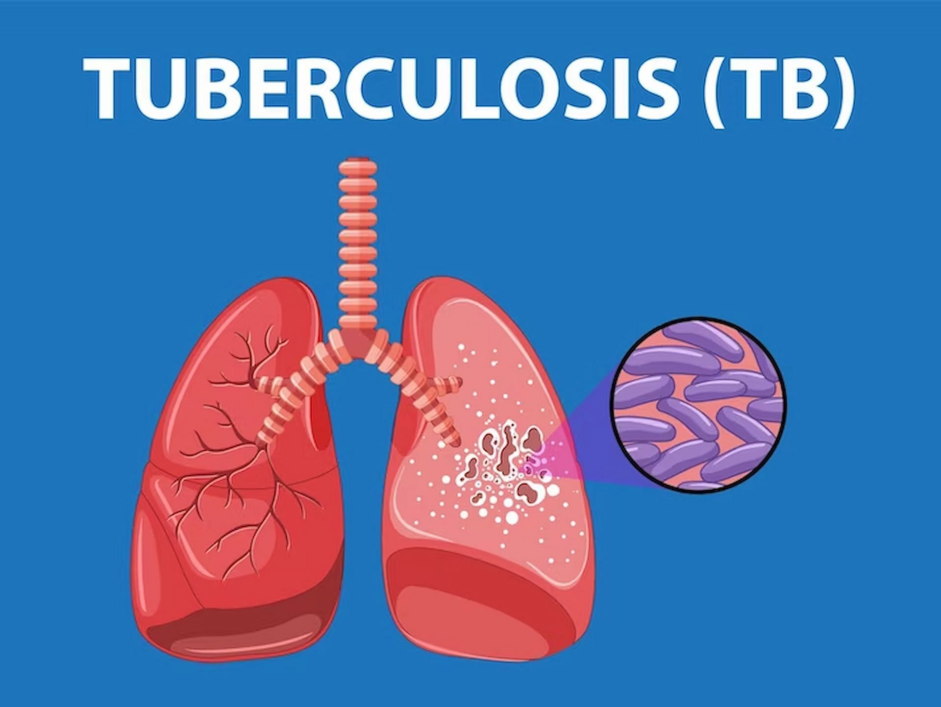 Diseases like tuberculosis are one of the leading causes of death worldwide (Image via freepik)