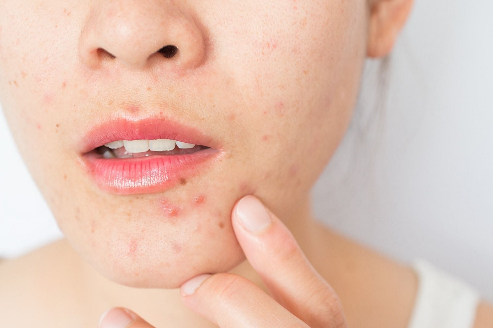 Cold sore and pimple (Image via BOY_ANUPONG/Getty Images)