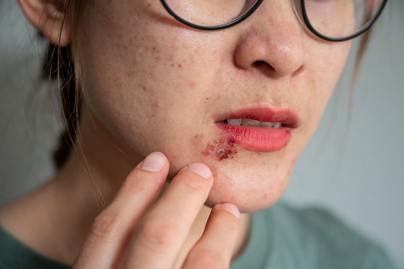 Cold sore and pimple (Image via BOY_ANUPONG/Getty Images)