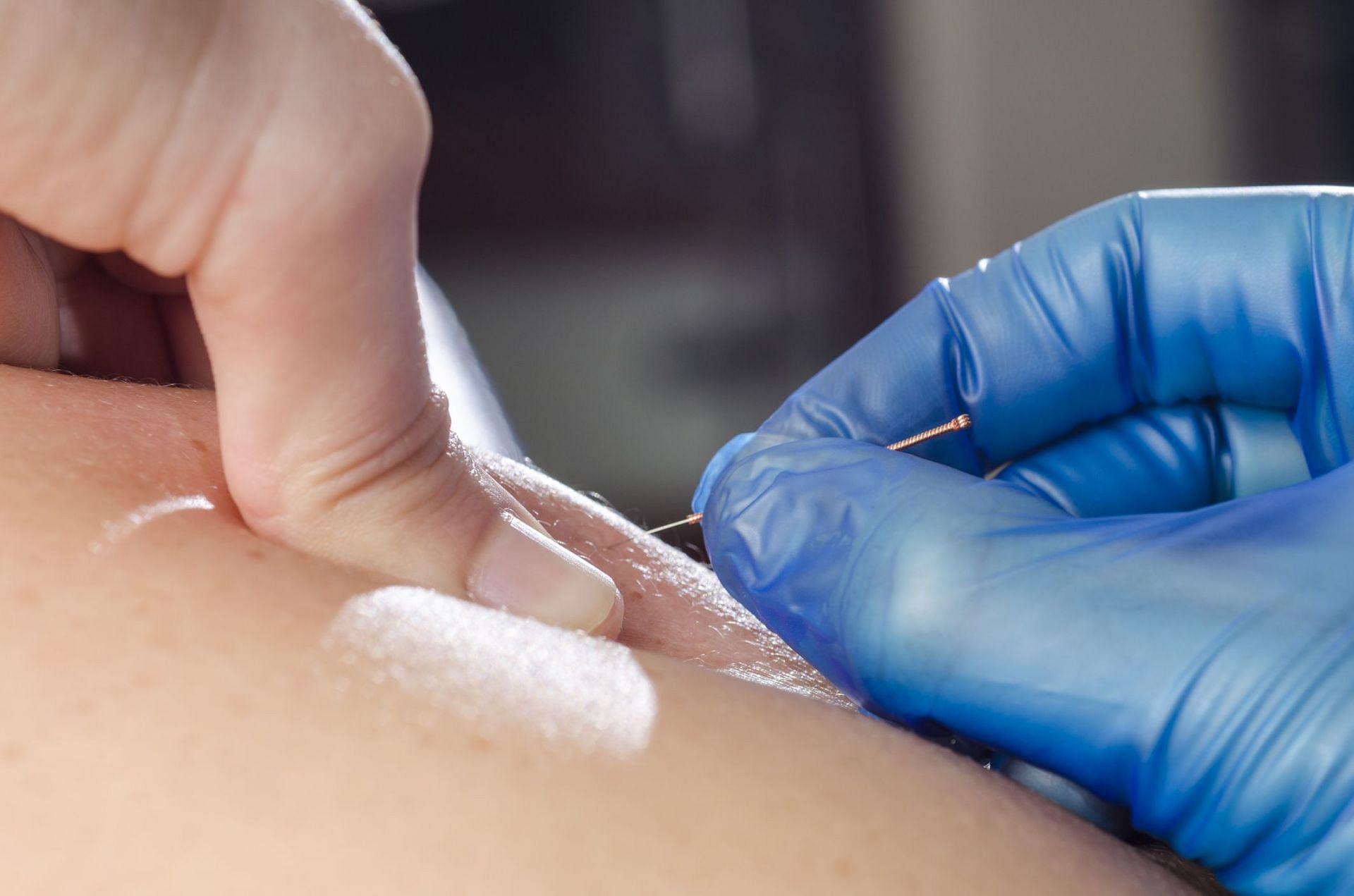 Dry needling vs. acupuncture (Image via Getty Images/ Sunlight19)