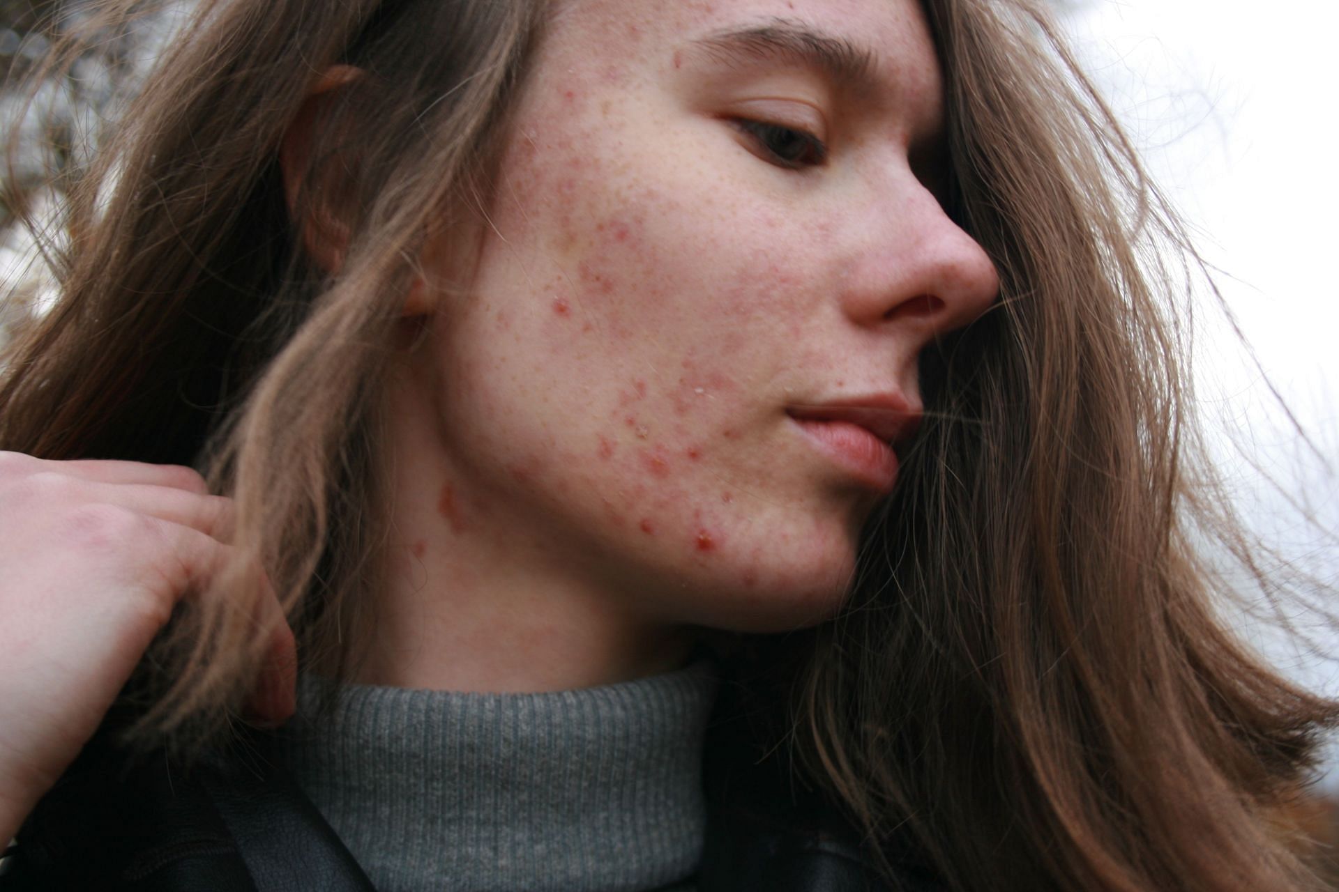 Different types of acne scars (Image via Unsplash / Barbara Krysztofiak)