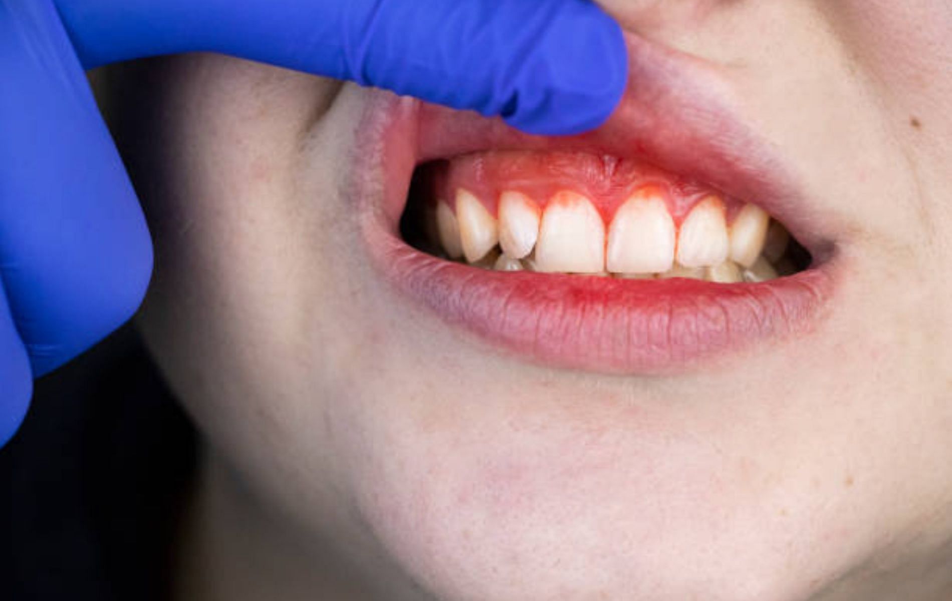 Oral trauma can also cause severe damage to the mucosal lining. (Image via iStockphoto)