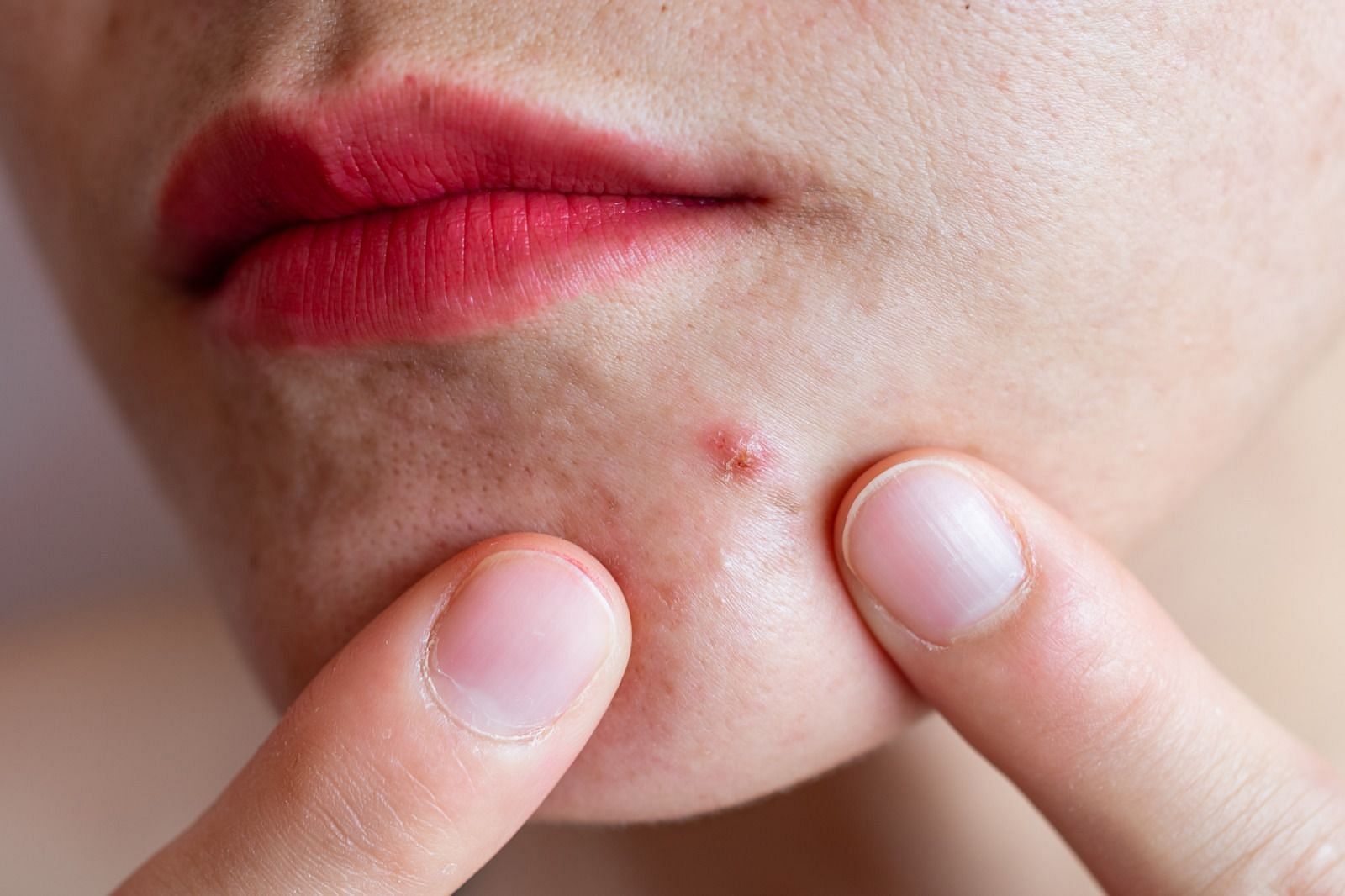 Cold sore and pimple (Image via Getty Images)